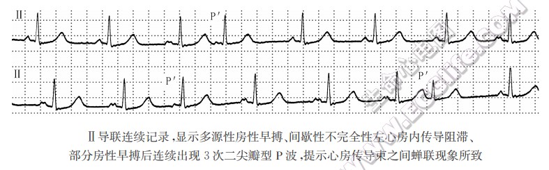 Ⅱ导联连续记录，显示多源性房性早搏、间歇性不完全性左心房内传导阻滞、部分房性早搏后连续出现3次二尖瓣型P波，提示心房传导柬之间蝉联现象所致