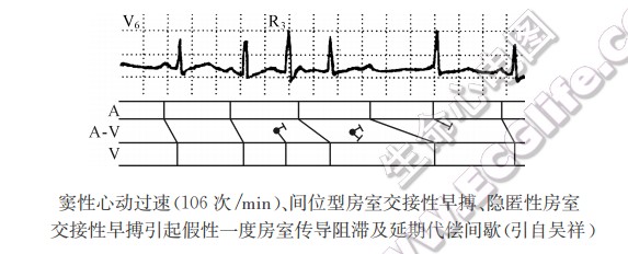 窦性心动过速(106次/min)、间位型房室交接性早搏、隐匿性房室交接性早搏引起假性一度房室传导阻滞及延期代偿间歇（引自吴祥）（心电图）