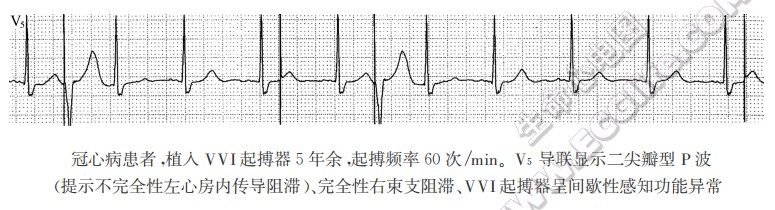 冠心病患者，植入VVI起搏器5年余，起搏频率60次/min。V5导联显示二尖瓣型P波（提示不完全性左心房内传导阻滞）、完全性右柬支阻滞、VVI起搏器呈间歇性感知功能异常