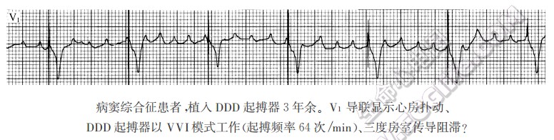 病窦综合征患者，植入DDD起搏器3年余。V1导联显示心房扑动、DDD起搏器以VVI模式工作(起搏频率64次/mjn)、三度房室传导阻滞