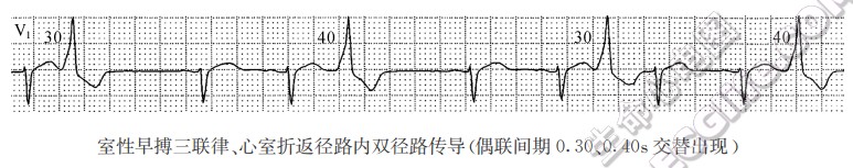 心房、心室折返径路内双径路、多径路传导