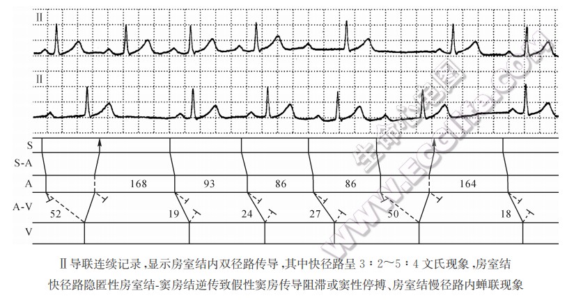 Ⅱ导联连续记录，显示房室结内双径路传导，其中快径路呈3：2~5：4文氏现象，房室结快径路隐匿性房室结一窦房结逆传致假性窦房传导阻滞或窦性停搏、房室结慢径路内蝉联现象