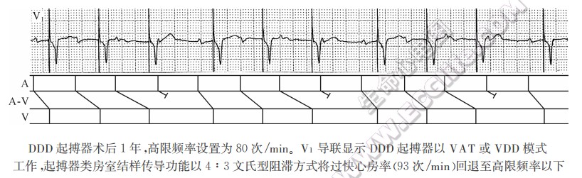 DDD起搏器术后1年，高限频率设置为80次/nin。V1导联显示DDD起搏器以VAT或VDD模式工作，起搏器类房室结样传导功能以4:3文氏型阻滞方式将过快心房率(93次/min)回退至高限频率以下