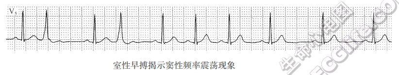 室性早搏揭示窦性频率震荡现象（心电图）