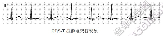 QRS-T波群电交替现象