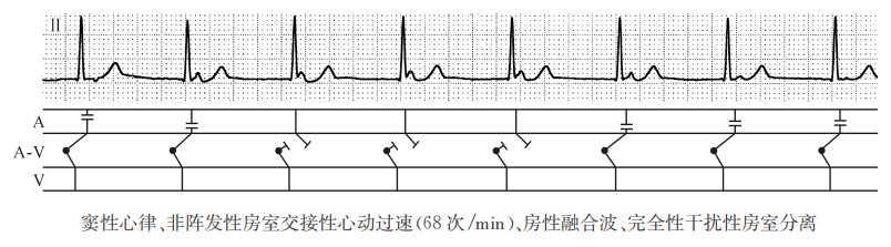 窦性心律、非阵发性房室交接性心动过速(68次/min)、房性融合波、完全性干扰性房室分离（心电图）