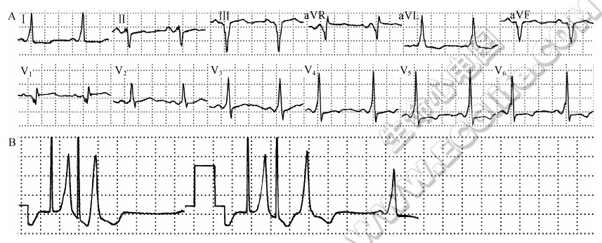 房室旁道内双径路传导心电图