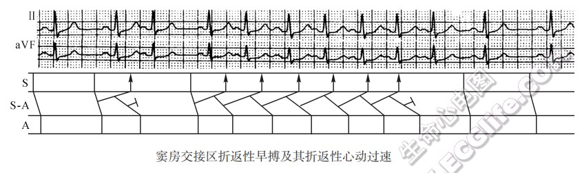 窄QRS心动过速的类型及心电图特征