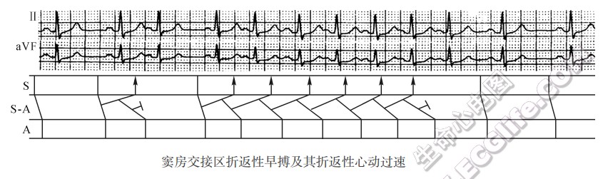 窦房交接区折返性早搏及其折返性心动过速（心电图）