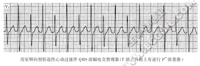 房室顺向型折返性心动过速伴QRS波幅电交替现象（心电图）