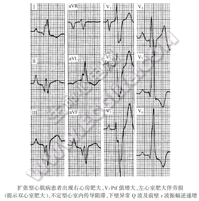 扩张型心肌病患者出现右心房肥大、V1Ptf值增大、左心室肥大伴劳损（提示双心室肥大）、不定型心室内传导阻滞、下壁异常Q波及前壁r波振幅逆递增