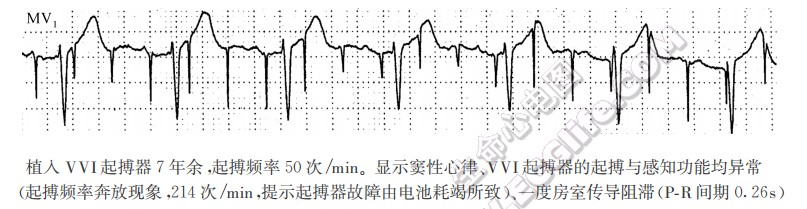 植入VVI起搏器7年余，起搏频率50次/min。显示窦性心律、VVI起搏器的起搏与感知功能均异常（起搏频率奔放现象，214次/min，提示起搏器故障由电池耗竭所致）、一度房室传导阻滞(PR间期0.26s)