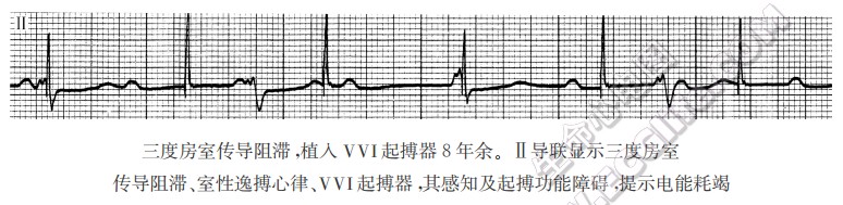 三度房室传导阻滞，植入VVI起搏器8年余。Ⅱ导联显示三度房室传导阻滞、室性逸搏心律、VVI起搏器，其感知及起搏功能障碍，提示电能耗竭