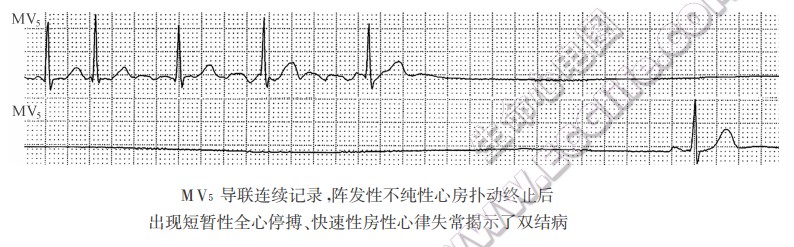 MV5导联连续记录，阵发性不纯J陛心房扑动终止后出现短暂性全心停搏、快速性房性心律失常揭示了双结病（心电图）