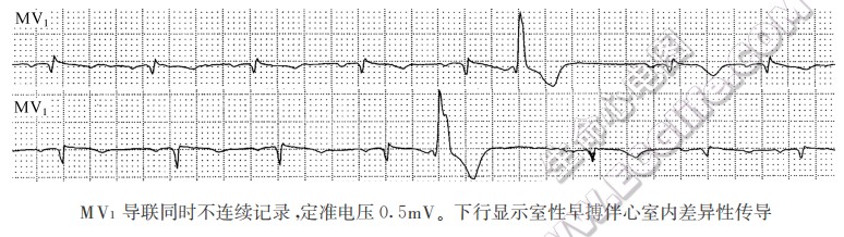 MV1导联同时不连续记录，定准电压0.5mV。下行显示室性早搏伴心室内差异性传导（心电图）