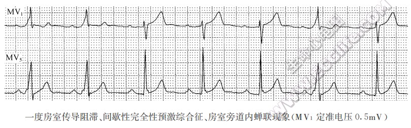 房室旁道内蝉联现象（心电图）