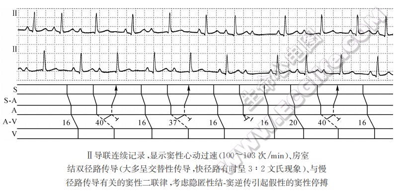 房室结快、慢径路交替性传导伴隐匿性结-窦逆传引起假性的窦性停搏