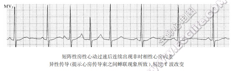 短阵性房性心动过速后连续出现非时相性心房内差异性传导（提示心房传导柬之间蝉联现象所致）、轻度T波改变