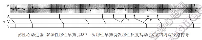 早搏、逸搏揭示房室结内双径路、多径路传导