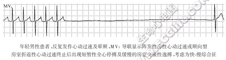 快-慢综合征（心电图）