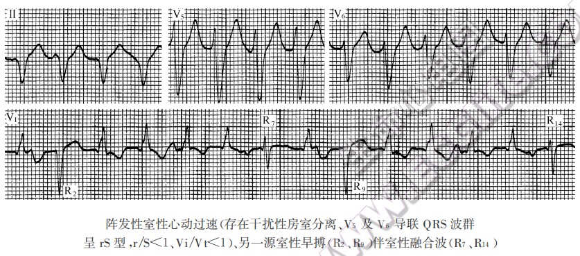阵发性室性心动过速（心电图）