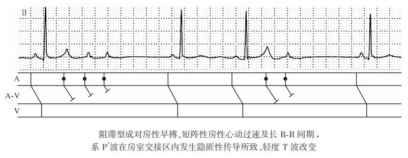 阻滞型成对房性早搏、短阵性房性心动过速及长RR间期，系P'波在房室交接区内发生隐匿性传导所致、轻度T波改变