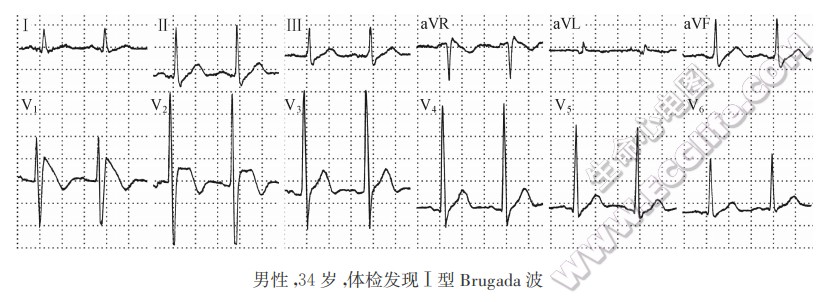 男性，34岁，体检发现Ⅰ型Brugada波（心电图）