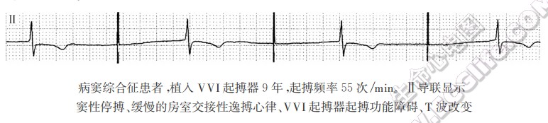 病窦综合征患者，植入VVI起搏器9年，起搏频率55次/min。Ⅱ导联显示窦性停搏、缓慢的房室交接性逸搏心律、VVI起搏器起搏功能障碍、T波改变