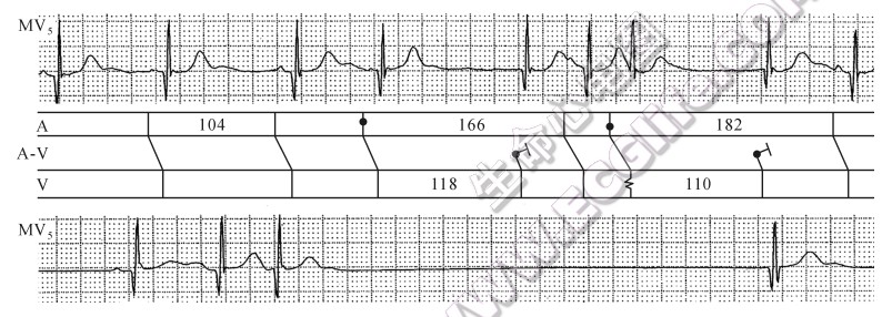 由成对房性早搏揭示了双结病（心电图）