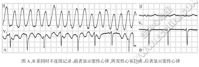 图A、B系同时不连续记录，前者显示窦性心律、阵发性心室扑动，后者显示窦性心律（心电图）