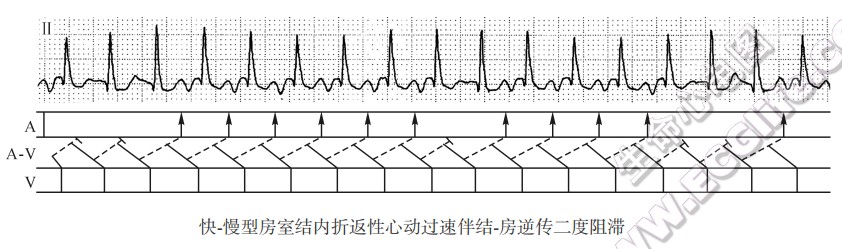 快-慢型房窒结内折返性心动过速伴结-房逆传二度阻滞（心电图）