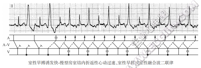 室性早搏诱发快．慢型房室结内折返性心动过速、室性早搏或窒性融合波二联律（心电图）