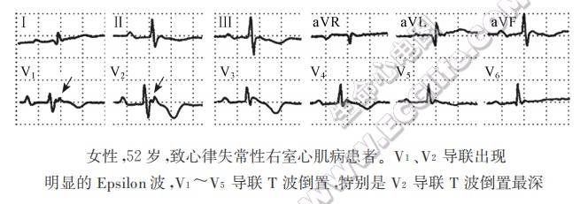 女性，52岁，致心律失常性右室心肌病患者。v1、v2导联出现明显的Epsilon波，V1～V5导联T波倒置，特别是V2导联T波倒置最深（心电图）