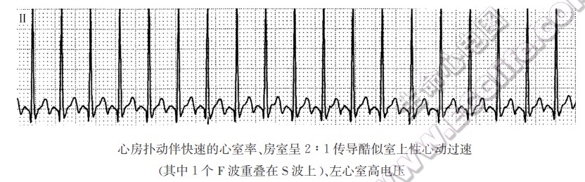 心房扑动伴快速的心室率、房室呈2:1传导酷似室上性心动过速（心电图）
