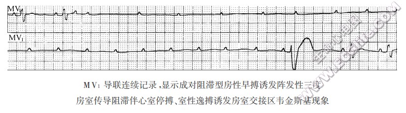 房性早搏诱发阵发性二度、三度房室传导阻滞（心电图）