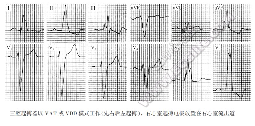 三腔起搏器以VAT或VDD模式工作（先右后左起搏），右心室起搏电极放置在右心室流出道