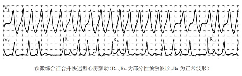 预激综合征合并快速型心房颤动(R4、R14为部分性预激波形，R8为正常波形)