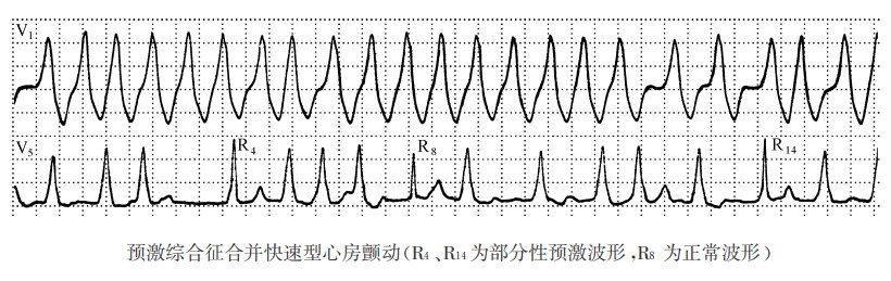 预激综合征合并心房颤动、扑动的心电图