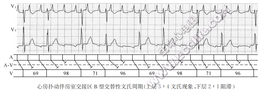 心房扑动伴房室交接区B型交替性文氏周期