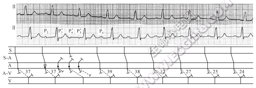 短阵性房性心动过速揭示窦性并行心律（心电图）
