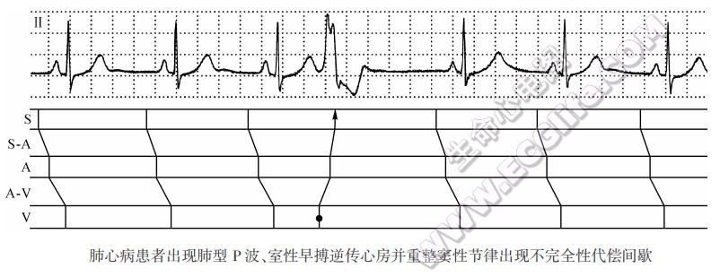 肺心病患者出现肺型P波、室性早搏逆传心房并重整窦性节律出现不完全性代偿间歇