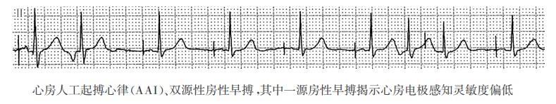 心房人工起搏心律(AAI)、双源性房性早搏，其中一源房性早搏揭示心房电极感知灵敏度偏低