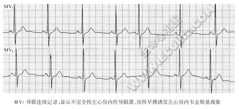 MV5导联连续记录湿示不完全f生左心房内传导阻滞、房性早搏污发左心房内韦金斯基现象