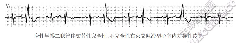 房性早搏二联律伴交替性完全性、不完全性右束支阻滞型心室内差异性传导（心电图）