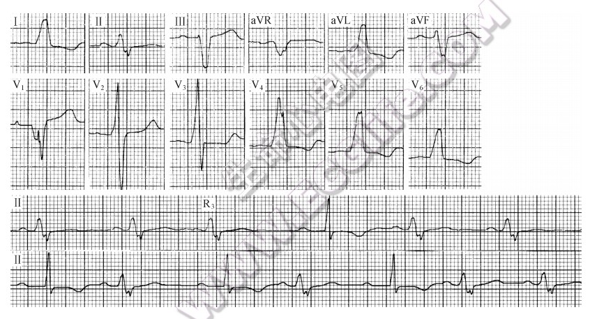 旁道一度阻滞合并一度房室传导阻滞-心电图