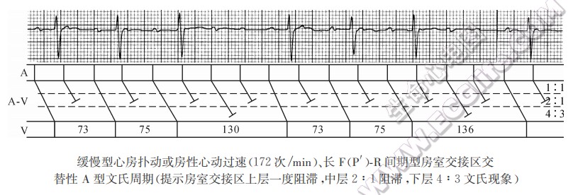 长PR间期型交替性文氏周期A型