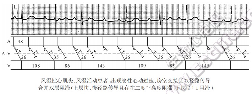 风湿性心肌炎、风湿活动患者，出现窦性心动过速、房室交接区双径路传导合并双层阻滞（心电图）