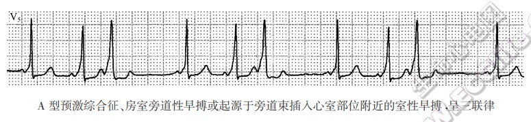 A型预激综合征、房室旁道性早搏或起源于旁道柬插入心室部位附近的室性早搏，呈三联律（心电图）