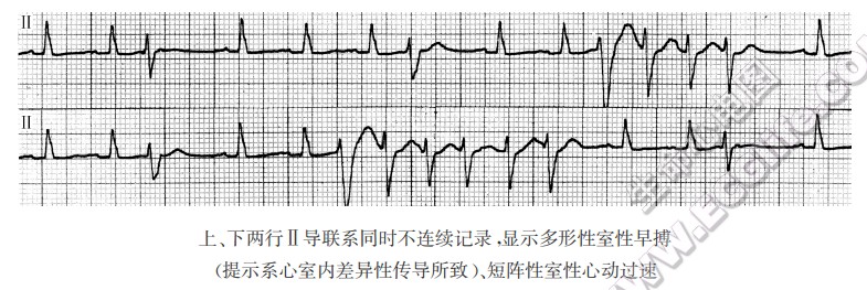 上、下两行Ⅱ导联系同时不连续记录，显示多形性室性早搏