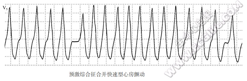 预激综合征合并快速型心房颤动（心电图）